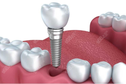 2022年种植牙新政策：种植牙补贴政策／纳入集采降价／免费种牙